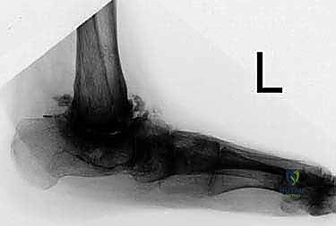 صورة توضيحية لـ تثبيت مفصل الكاحل والقدم (Tibial-Calcaneal Arthrodesis): حل جذري لفقدان عظم الكاحل والعدوى