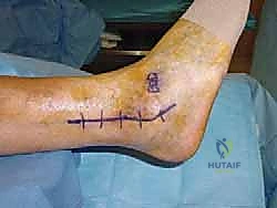 التثبيت الداخلي باستخدام المسامير النخاعية أو الشرائح