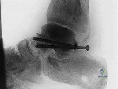 وصف طبي دقيق للمريض والنخر اللاوعائي