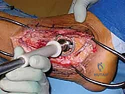 إدخال الطعم العظمي وضبط المحور الميكانيكي للقدم