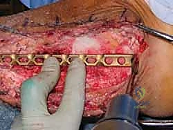 صورة توضيحية لـ دمج مفصل الكاحل والقدم الخلفية باستخدام الطعم العظمي من رأس عظم الفخذ حلول معقدة على يد الأستاذ الدكتور محمد هطيف