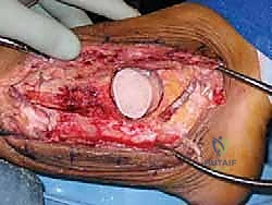 تشكيل الطعم العظمي ليتناسب مع الفجوة