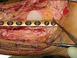 دمج مفصل الكاحل والقدم الخلفية باستخدام الطعم العظمي من رأس عظم الفخذ حلول معقدة على يد الأستاذ الدكتور محمد هطيف