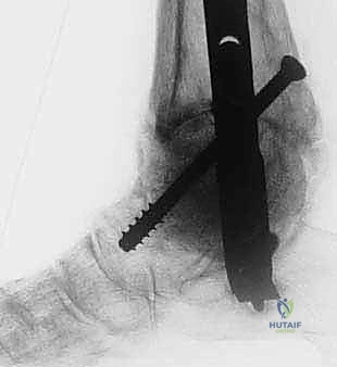 FIG 3  AP  A  and lateral  B  radiographs taken 3 months postoperatively demonstrating callus formation about the femoral head allograft