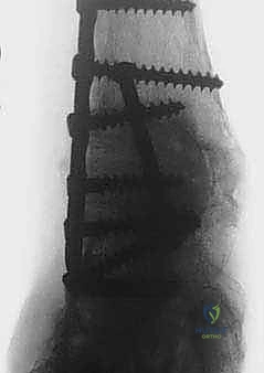 Tibiotalocalcaneal Fusion with Femoral Head Allograft: A Masterclass in Complex Hindfoot Reconstruction