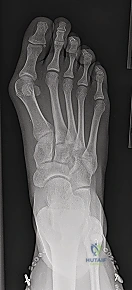 Mastering Juvenile Bunion Correction: A Mitchell Osteotomy Intraoperative Guide