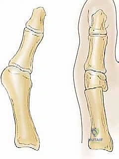 التعافي وتثبيت العظام بعد جراحة ميشيل اليافع