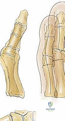 خطوات جراحة ميشيل المعدلة لتصحيح إبهام القدم