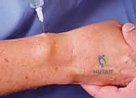 صورة توضيحية لـ إزالة تعصيب الرسغ: حل متقدم لآلام الرسغ المزمنة والمستعصية مع الأستاذ الدكتور محمد هطيف في صنعاء