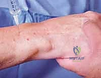 صورة توضيحية لـ إزالة تعصيب الرسغ: حل متقدم لآلام الرسغ المزمنة والمستعصية مع الأستاذ الدكتور محمد هطيف في صنعاء