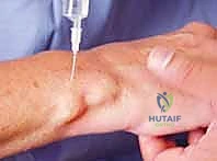 صورة توضيحية لـ إزالة تعصيب الرسغ: حل متقدم لآلام الرسغ المزمنة والمستعصية مع الأستاذ الدكتور محمد هطيف في صنعاء