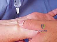 صورة توضيحية لـ إزالة تعصيب الرسغ: حل متقدم لآلام الرسغ المزمنة والمستعصية مع الأستاذ الدكتور محمد هطيف في صنعاء