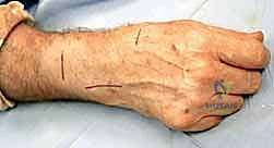 صورة توضيحية لـ إزالة تعصيب الرسغ: حل متقدم لآلام الرسغ المزمنة والمستعصية مع الأستاذ الدكتور محمد هطيف في صنعاء