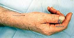 إزالة تعصيب الرسغ: حل متقدم لآلام الرسغ المزمنة والمستعصية مع الأستاذ الدكتور محمد هطيف في صنعاء