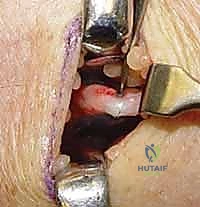 صورة توضيحية لـ إزالة تعصيب الرسغ: حل متقدم لآلام الرسغ المزمنة والمستعصية مع الأستاذ الدكتور محمد هطيف في صنعاء