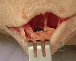 صورة توضيحية لـ إزالة تعصيب الرسغ: حل متقدم لآلام الرسغ المزمنة والمستعصية مع الأستاذ الدكتور محمد هطيف في صنعاء