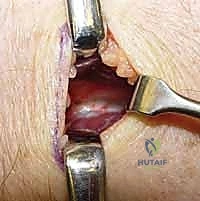 صورة توضيحية لـ إزالة تعصيب الرسغ: حل متقدم لآلام الرسغ المزمنة والمستعصية مع الأستاذ الدكتور محمد هطيف في صنعاء