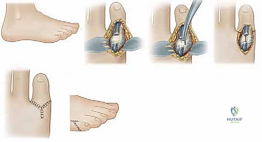 Illustration of overlapping fifth toe - Dr. Mohammed Hutaif