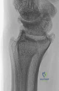 استئصال الزائدة الإبرية الكعبرية: دليل شامل لعلاج خشونة الرسغ المفتوح مع الأستاذ الدكتور محمد هطيف