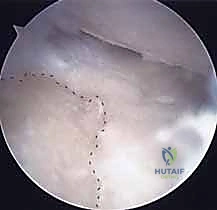 تشريح مفصل الرسغ والزائدة الإبرية