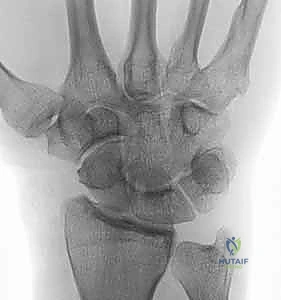 التحضير الجراحي والتخطيط لعملية الرسغ