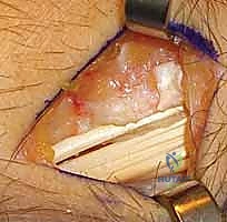 التشخيص بالأشعة السينية لخشونة الرسغ