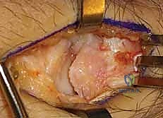 إغلاق الجرح والنتائج الفورية بعد الجراحة