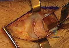 صورة توضيحية لـ استئصال الزائدة الإبرية الكعبرية: دليل شامل لعلاج خشونة الرسغ المفتوح مع الأستاذ الدكتور محمد هطيف