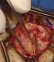 تأهيل المريض واستخدام الجبائر بعد العملية