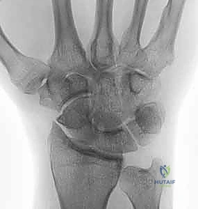 الفحص السريري لآلام الرسغ والزائدة الإبرية