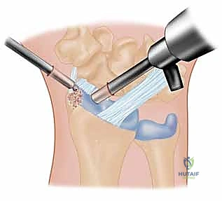 خطوات استئصال العظم أثناء الجراحة المفتوحة
