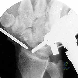 Mastering Radial Styloidectomy: An Open Surgical Approach for Radiocarpal Arthritis