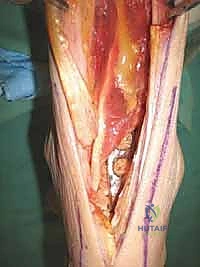 FIG 8  Weight-bearing lateral radiograph 3 months postoperatively