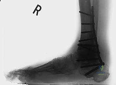 FIG 8  Weight-bearing lateral radiograph 3 months postoperatively
