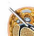 الآفات الغضروفية العظمية في قبة الكاحل