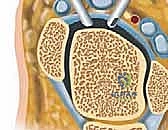 الانحشار الأمامي في الكاحل وتكون النتوءات العظمية