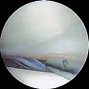 صورة توضيحية لـ منظار الكاحل: دليل شامل للعلاج الدقيق لمفصل القدم مع الأستاذ الدكتور محمد هطيف في صنعاء