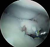 صورة توضيحية لـ منظار الكاحل: دليل شامل للعلاج الدقيق لمفصل القدم مع الأستاذ الدكتور محمد هطيف في صنعاء