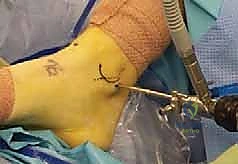 صورة طبية: منظار الكاحل: دليل شامل للعلاج الدقيق لمفصل القدم مع الأستاذ الدكتور محمد هطيف في صنعاء