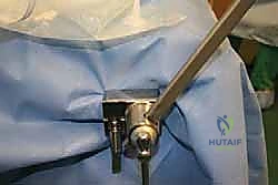 Ankle Arthroscopy: A Masterclass in Minimally Invasive Tibiotalar Joint Management