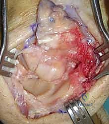 استئصال الصف القريب من عظام الرسغ: حل متقدم لآلام المعصم المزمنة وتآكل المفاصل