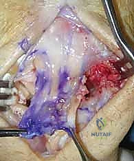 التشخيص الإشعاعي الدقيق لتآكل عظام الرسغ