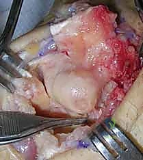 التغيرات الميكانيكية الحيوية بعد استئصال الصف القريب من الرسغ