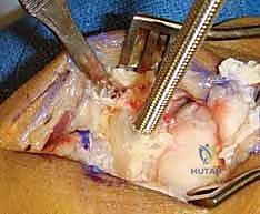 تقييم رأس العظم الرأسي لضمان نجاح المفصل الجديد