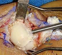 إزالة العظم الزورقي والهلالي والمثلثي بدقة