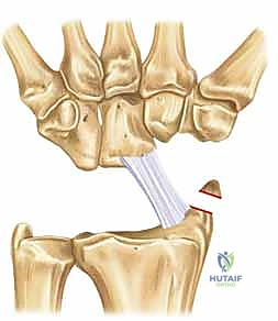 إغلاق المحفظة المفصلية وتثبيت الرسغ