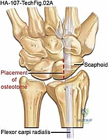 حالات تآكل مفصل الرسغ المتقدمة التي تتطلب تدخلاً جراحياً