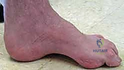 الأسباب العصبية للقدم الجوفاء