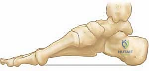 الأشعة السينية لتقييم قوس القدم