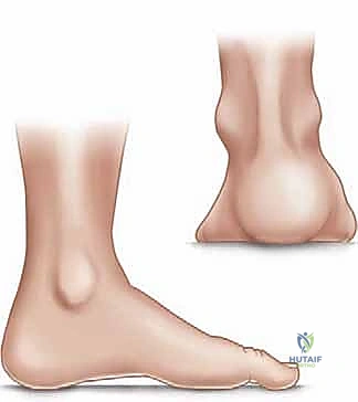 نقل الأوتار لتصحيح التوازن العضلي